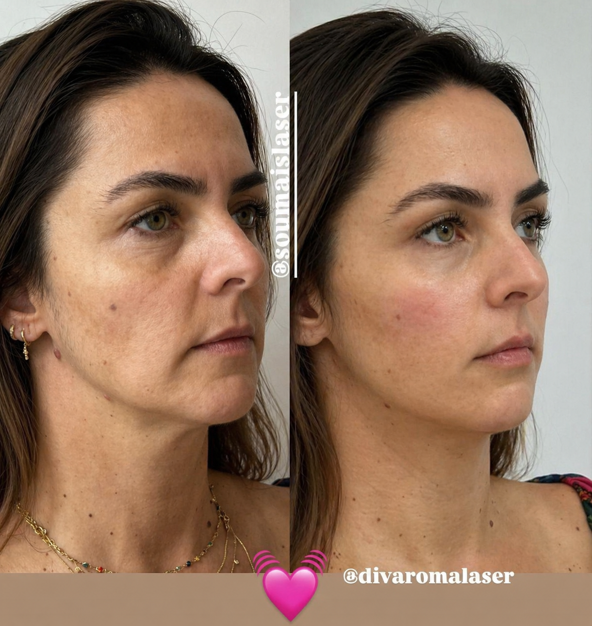 Resultado antes e depois 4